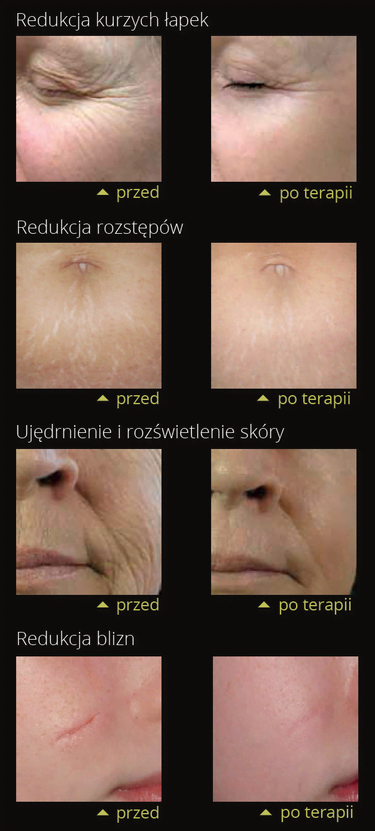 Belezo emerge efekty Belezo emerge redukcja rozstępów, blizn