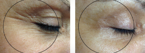 Belezo geneo efekty zabiegu Belezo geneo przed i po