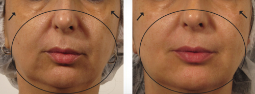 Belezo geneo efekty zabiegów Belezo geneo efety przed i po