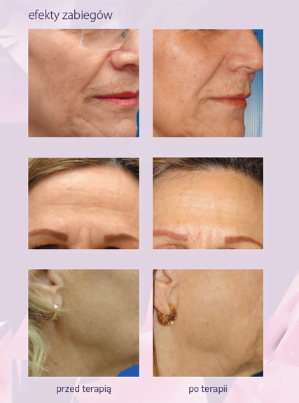 Belezo piekna i mloda skora Belezo poprawa kolorytu i struktury skóry