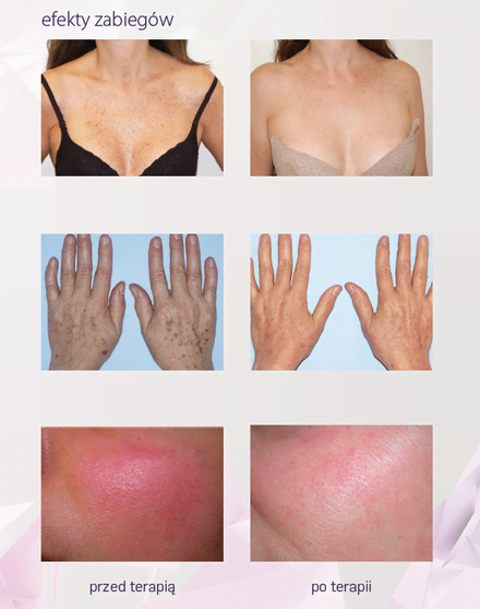 Belezo efekty zabiegów Belezo naczynks, przebarwienia, utrata jędrności skóry, trądzik, ryumień, naczyniaki